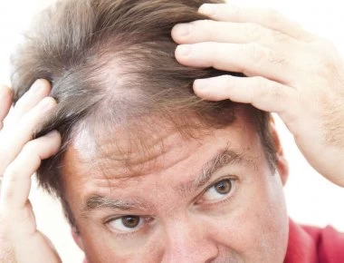 Tεστοστερόνη και απώλεια μαλλιών - Ποια η σχέση που τα συνδέει;